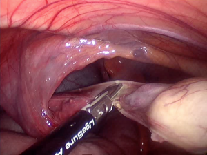 Système chirurgical de thermofusion tissulaire (Ligasure), cordon testiculaire