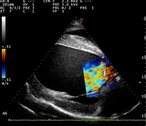 Echocardiographie doppler