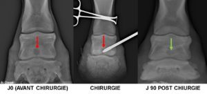 Kyste osseux sous chondral du PIED (2ème phalange)mise en place d’un implant biodégradable 