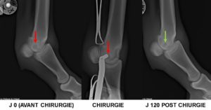 Kyste osseux sous chondral du BOULET (canon) mise en place d’un implant biodégradable 