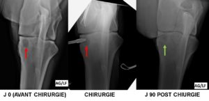 Kyste osseux sous chondral du COUDE (radius) mise en place d’un implant biodégradable 