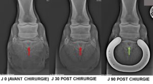 Kyste osseux sous chondral du PIED (3ème phalange) mise en place d’un implant biodégradable 