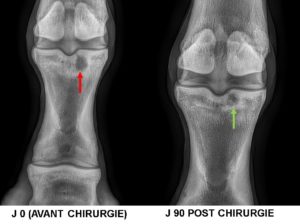 Kyste osseux sous chondral du BOULET (1ère phalange) mise en place d’un implant biodégradable 