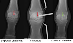 Kyste osseux sous chondral du BOULET (canon) mise en place d’un implant biodégradable 