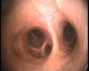 Visualisation de la carène bronchique au moyen de l’endoscope 